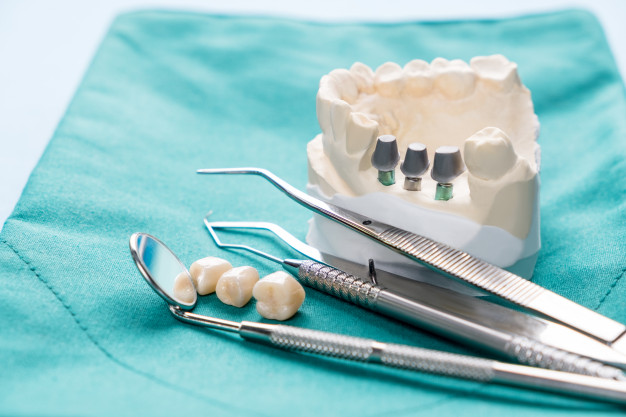 ایمپلنت چیست ، انواع کاشت دندان ثابت