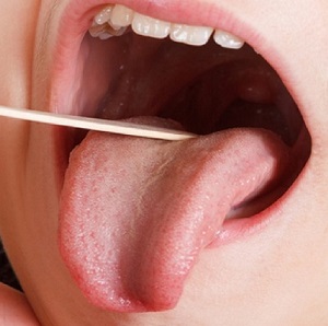 درمان زخم زبان و دهان
