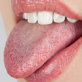 درمان زخم زبان و گلو