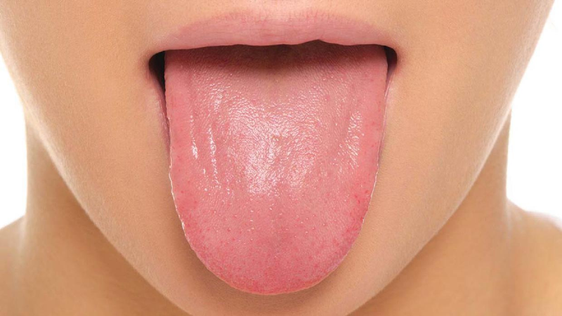 درمان زخم زبان و گلو
