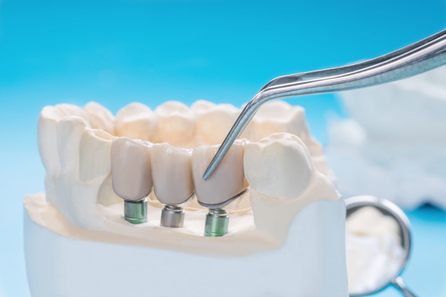 ایمپلنت دندان ، انواع ایمپلنت های دندانی