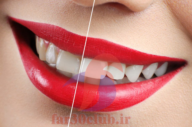 ژل سفید کننده دندان چیست ، ژل سفید کننده دندان در داروخانه